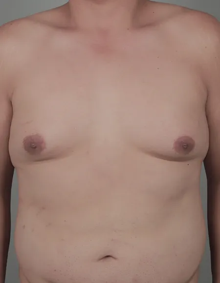 凡是与美 - 凡是与美B&A - 【男性】男性乳房缩小手术 前