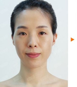 凡是与美 - 凡是与美B&A - 【鼻整形】鼻头肥大矫正+鼻翼缩小 前