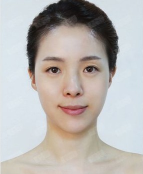 凡是与美 - 凡是与美B&A - 【鼻整形】鼻头肥大矫正+鼻翼缩小 后