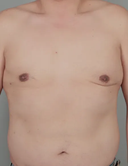 凡是与美 - 凡是与美B&A - 【男性】男性乳房缩小手术 后