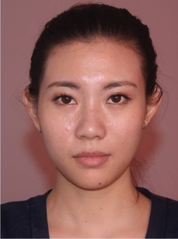 凡是与美 - B&A - 眼鼻综合:双眼皮与鼻梁 后