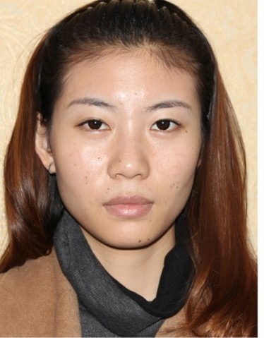 凡是与美 - B&A - 眼鼻综合:双眼皮与鼻梁 前