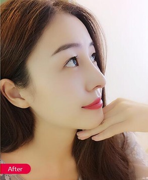 凡是与美 - 凡是与美B&A - 【面部】上睑下垂矫正+驼峰鼻矫正 后
