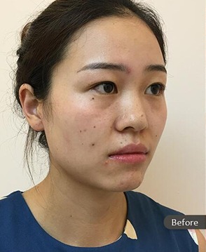 凡是与美 - 凡是与美B&A - 【面部】上睑下垂矫正+驼峰鼻矫正 前