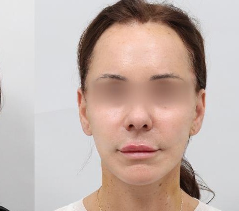 凡是与美 - 凡是与美B&A - 【全脸】下颌角缩小+眼整形+鼻整形 后