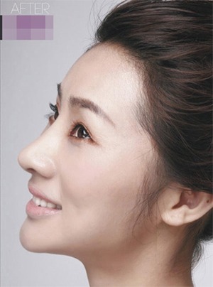凡是与美 - B&A - 眼鼻综合与面部年轻化 后