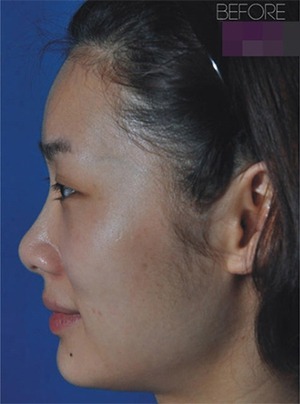 凡是与美 - B&A - 眼鼻综合与面部年轻化 前