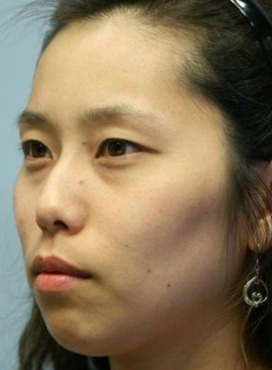 凡是与美 - B&A - 鼻修复 前