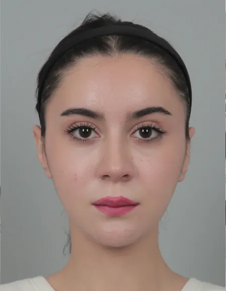 凡是与美 - B&A - 面部提升与年轻化 后