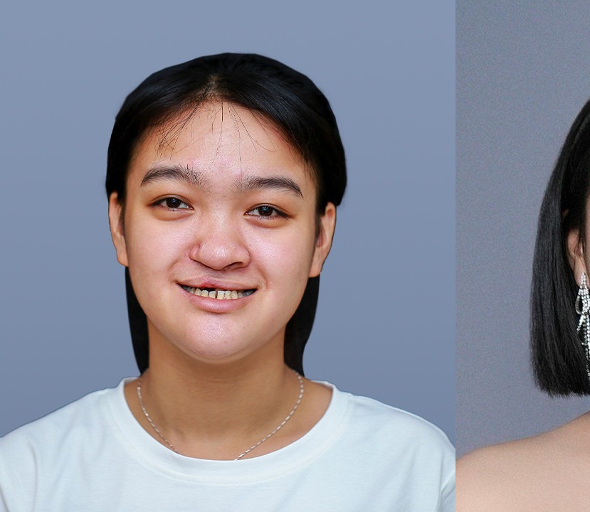 凡是与美 - B&A - 正颌、面部轮廓与鼻部整形 前
