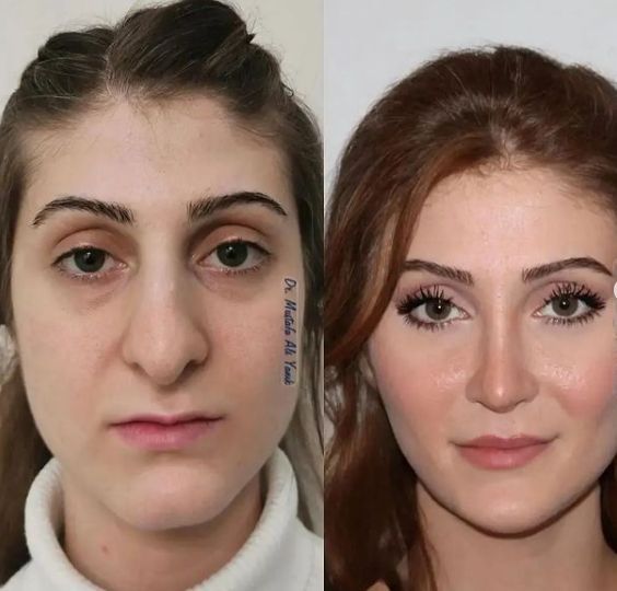 凡是与美 - 凡是与美B&A - 【鼻子】初次鼻部手术+鼻整形 前