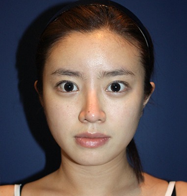 凡是与美 - B&A - 面部轮廓、眼部与鼻部整形 后