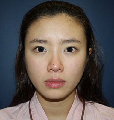 凡是与美 - B&A - 面部轮廓、眼部与鼻部整形 前