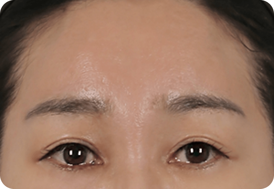 凡是与美 - Full 面部lift - Endotine 额头提升 第3步
