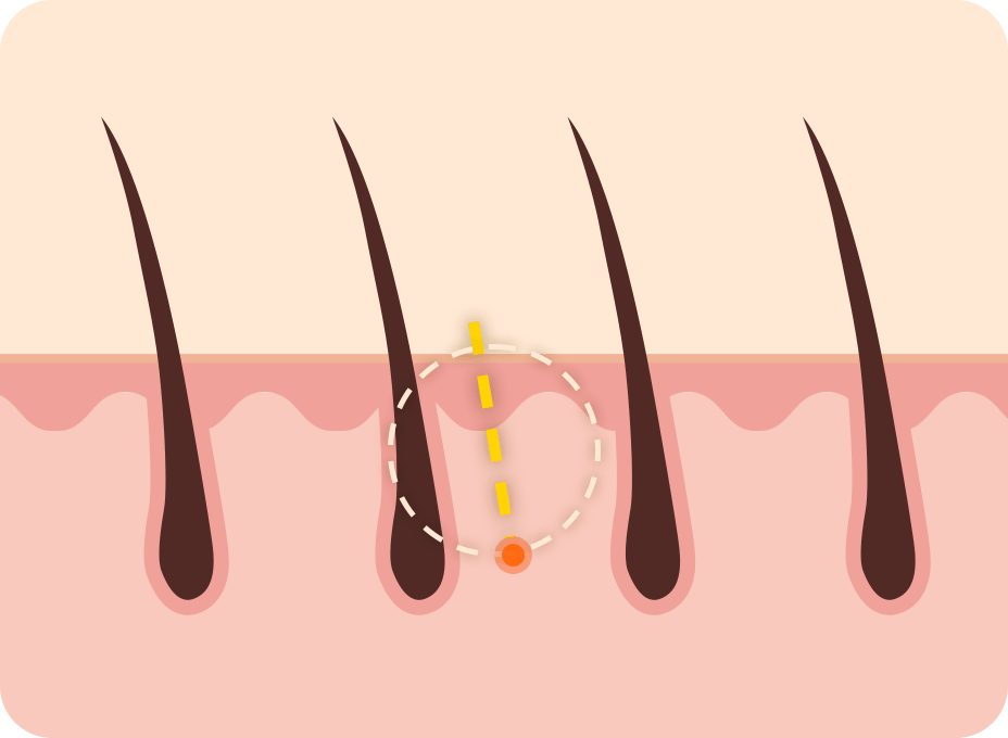 凡是与美 - Mini Forehead 迷你双下巴提升 - Mini 额头提升 No Hair Loss