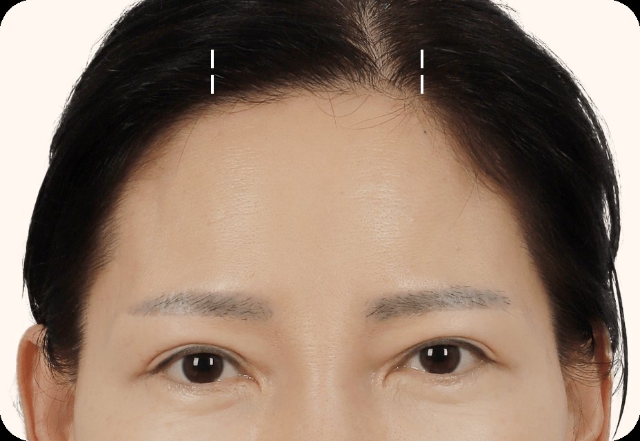 凡是与美 - Mini Forehead 迷你双下巴提升 - Mini 额头提升 第1步