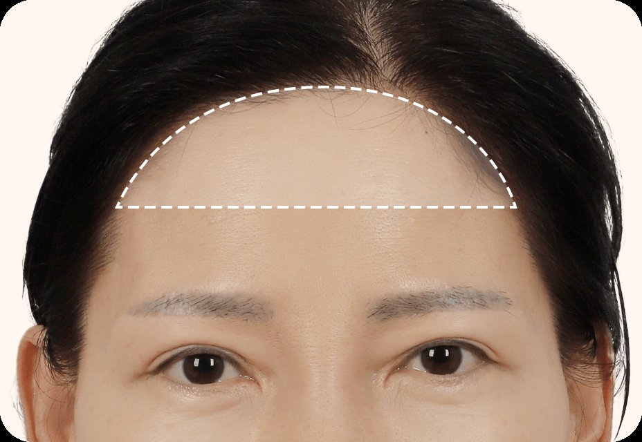 凡是与美 - Mini Forehead 迷你双下巴提升 - Mini 额头提升 第2步