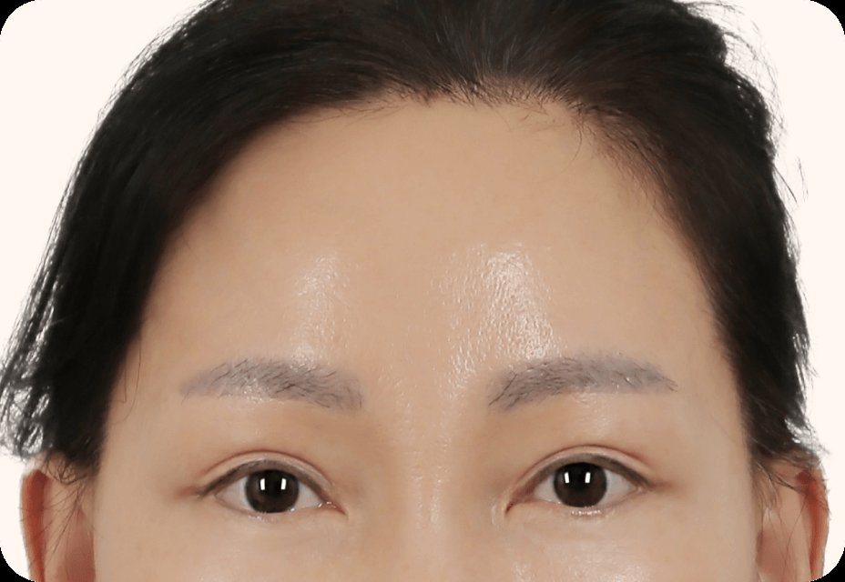 凡是与美 - Mini Forehead 迷你双下巴提升 - Mini 额头提升 第3步