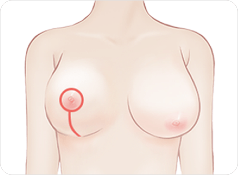凡是与美 - 缩胸术 - 垂直切口