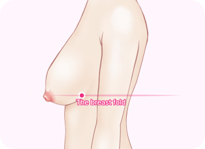 凡是与美 - 胸部 Lifting - 第2阶段