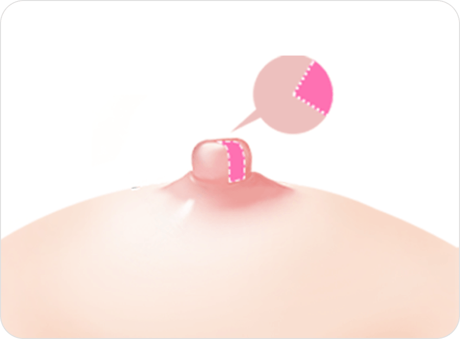 凡是与美 - 乳头矫正术 - Long Nipple Reduction 术前