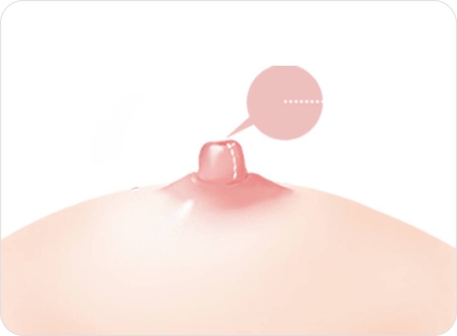 凡是与美 - 乳头矫正术 - Long Nipple Reduction 术后