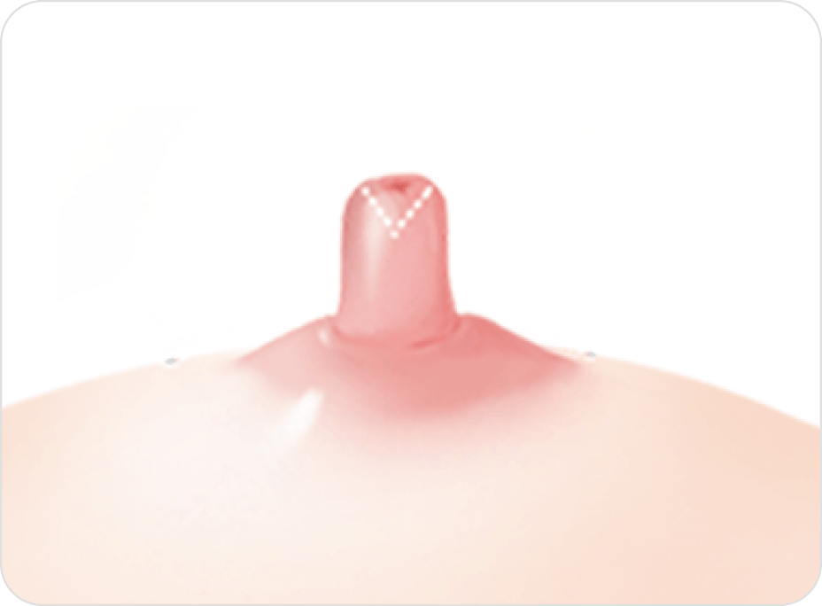 凡是与美 - 乳头矫正术 - 不保留乳腺管方法第1步
