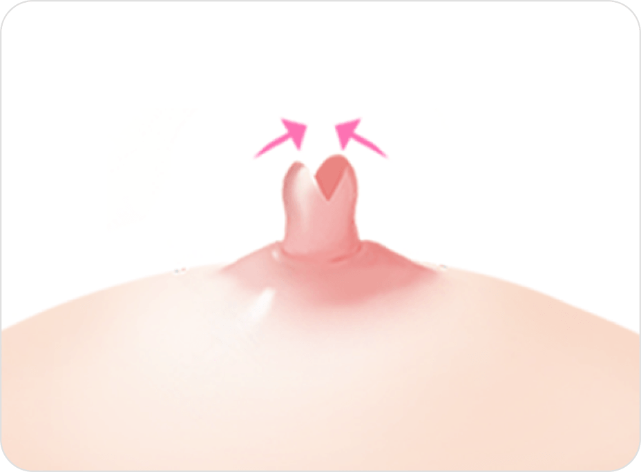 凡是与美 - 乳头矫正术 - 不保留乳腺管方法第2步