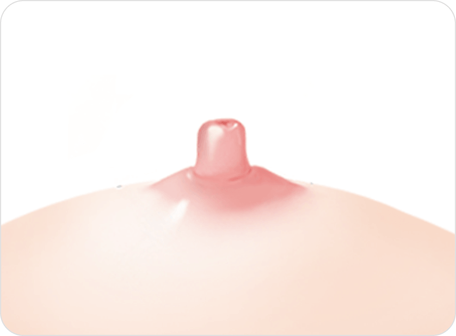 凡是与美 - 乳头矫正术 - 不保留乳腺管方法第3步