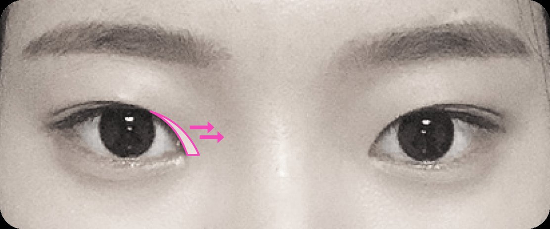 凡是与美 - Canthoplasty - 开内眼角 术前