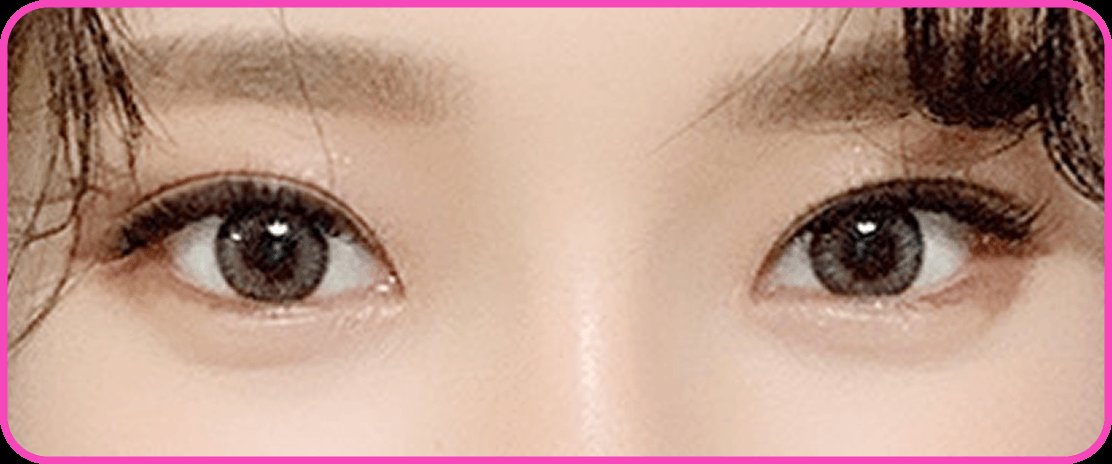 凡是与美 - Canthoplasty - 开内眼角 术后