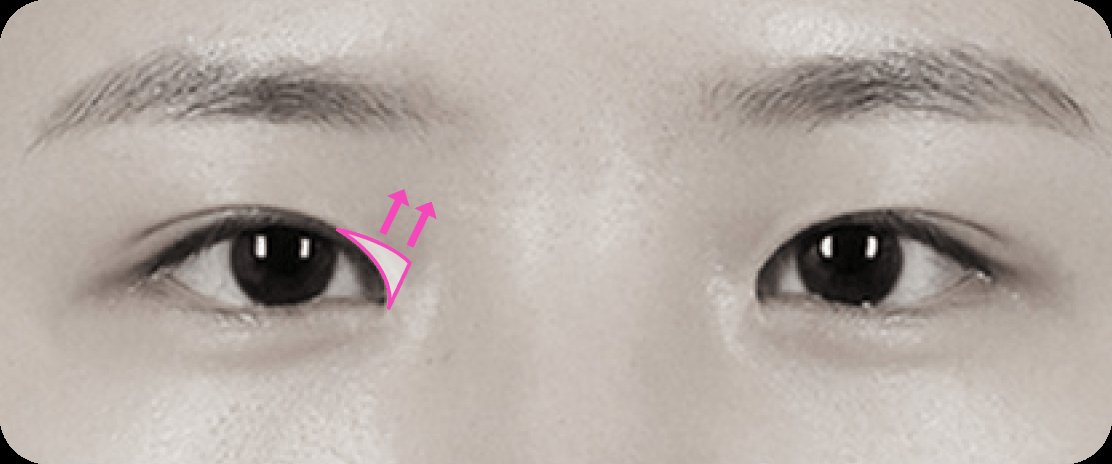 凡是与美 - Canthoplasty - 45度眼角成形术前