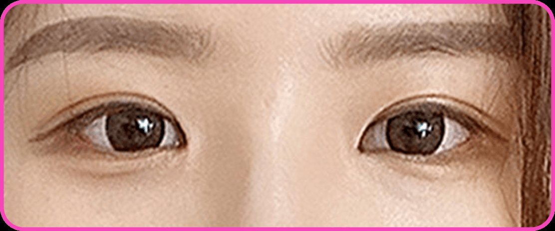 凡是与美 - Canthoplasty - 45度眼角成形术后