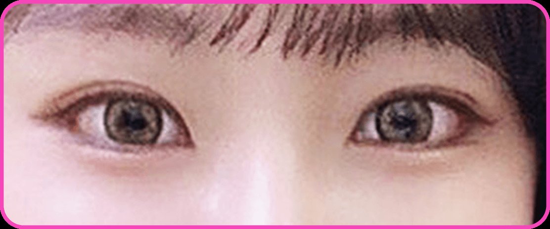 凡是与美 - Canthoplasty - 外眦开大术 术后