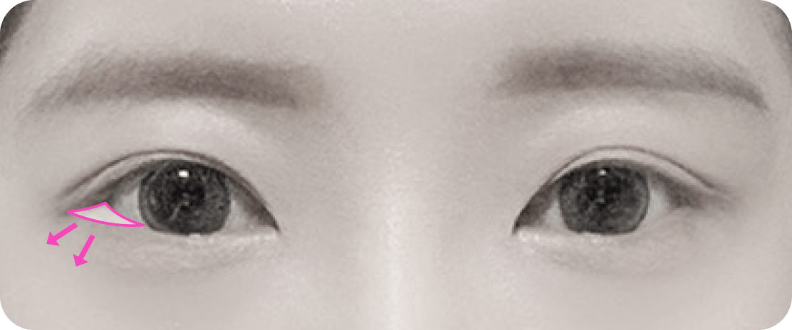 凡是与美 - Canthoplasty - 外侧 Hotz 眼眦整形 术前