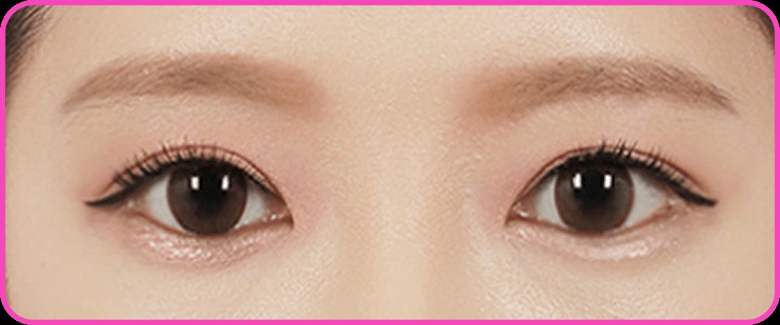 凡是与美 - Canthoplasty - 外侧 Hotz 眼眦整形 术后