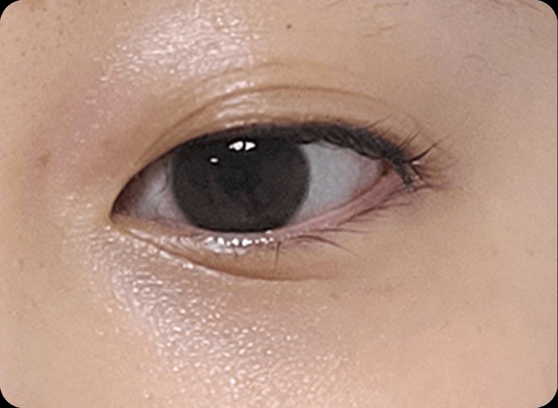 凡是与美 - 上睑下垂矫正术 - Droopy 眼部s 术前