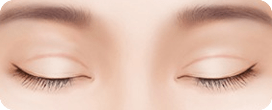 凡是与美 - 眼睑修复手术 - 疤痕明显的双眼皮线