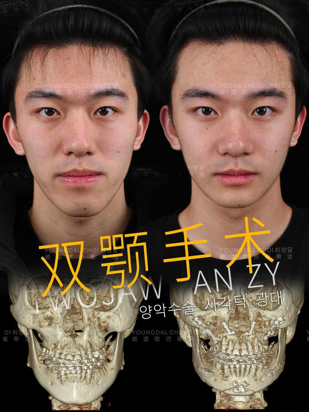 男性双颚手术 正面观 术前 / 术后 + 3D 骨骼对照