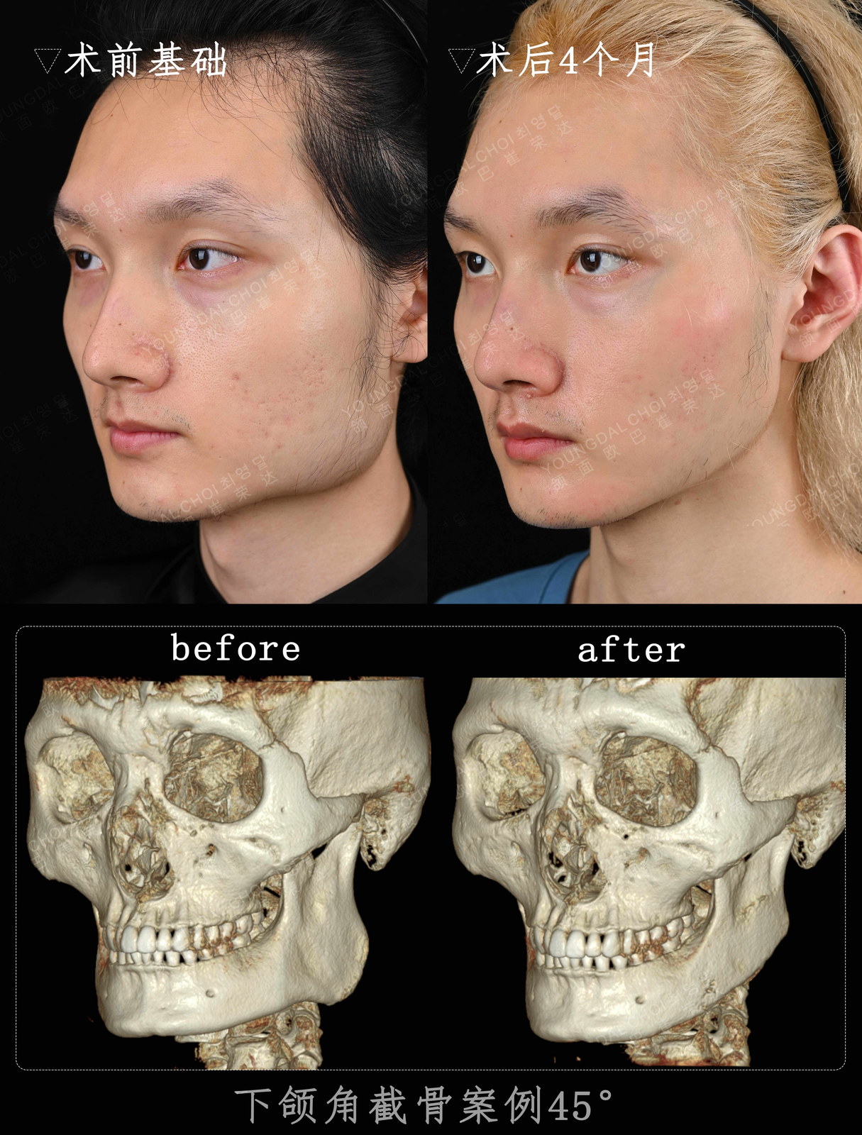 男性下颌角截骨 45° 术前基础 / 术后 4 个月 + 3D 骨骼对照