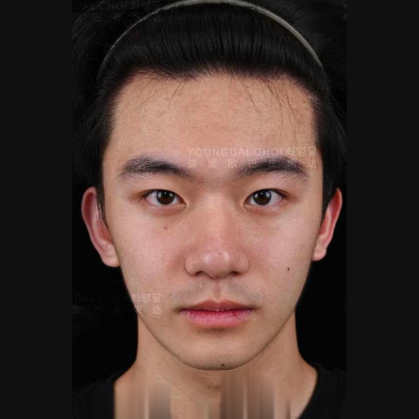 下颌线 术后