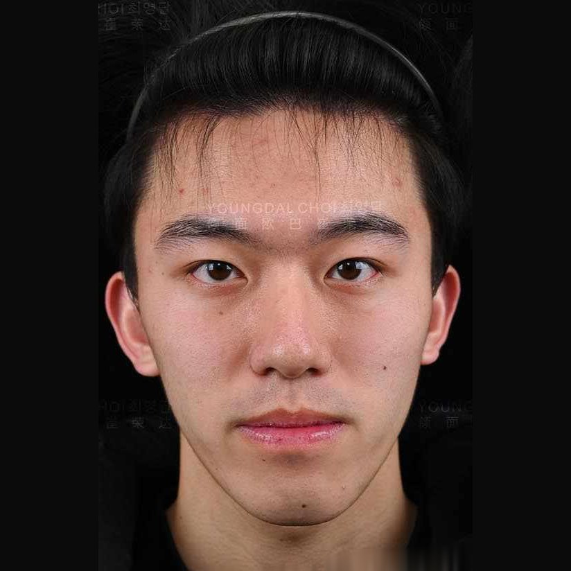 术前