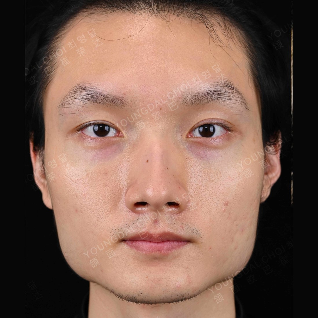 术前
