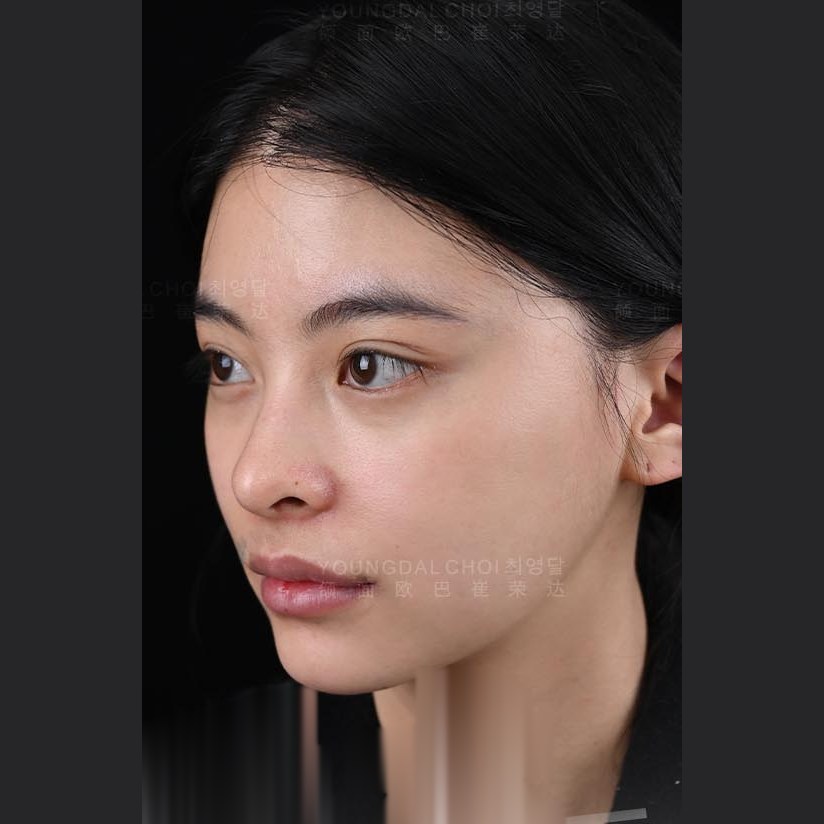 术后 6 个月