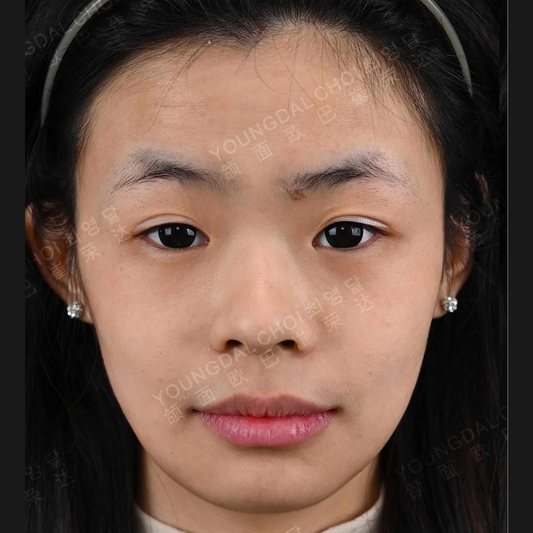 术后 6 个月