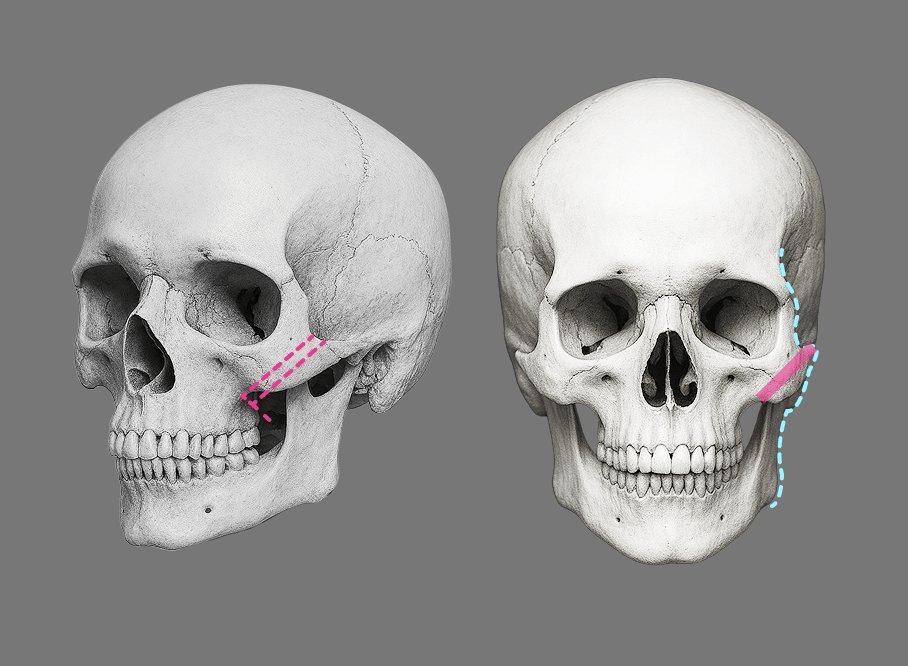 凡是与美 - High-L Cheekbone Reduction - L型截骨与传统Low-L
