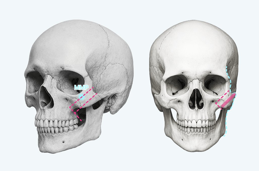 凡是与美 - High-L Cheekbone Reduction - 凡是与美 High-L Osteotomy