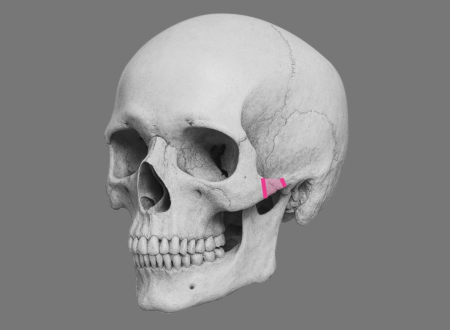 凡是与美 - High-L Cheekbone Reduction - 传统方法