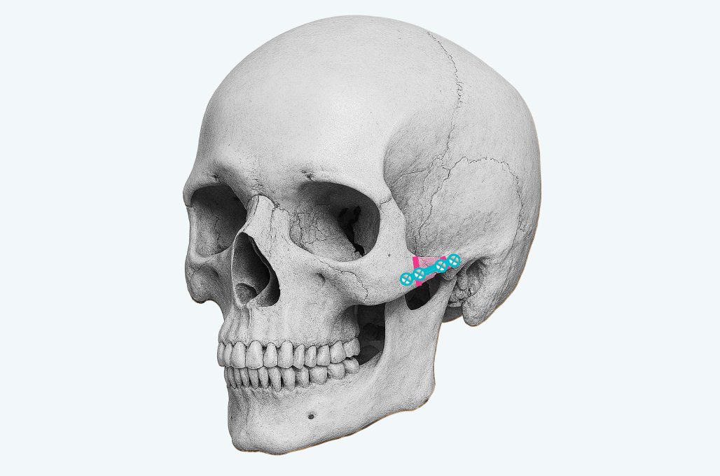凡是与美 - High-L Cheekbone Reduction - 凡是与美 Quick Cheekbone Reduction