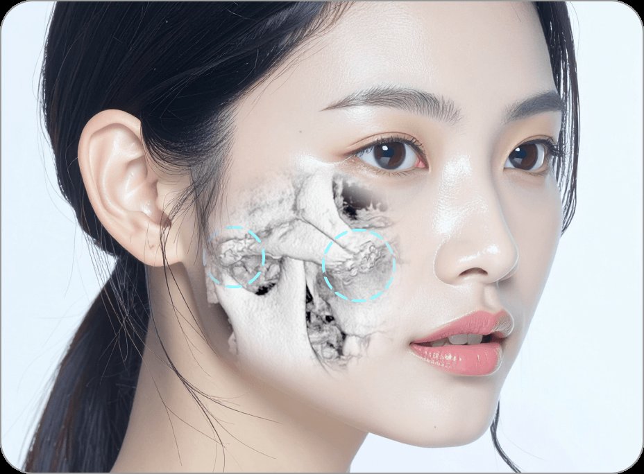 凡是与美 - High-L Cheekbone Reduction - 手术方法第3步